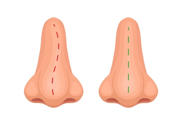 Krzywy i prawidłowy nos Nos przed i po leczeniu Ilustracja wektorowa