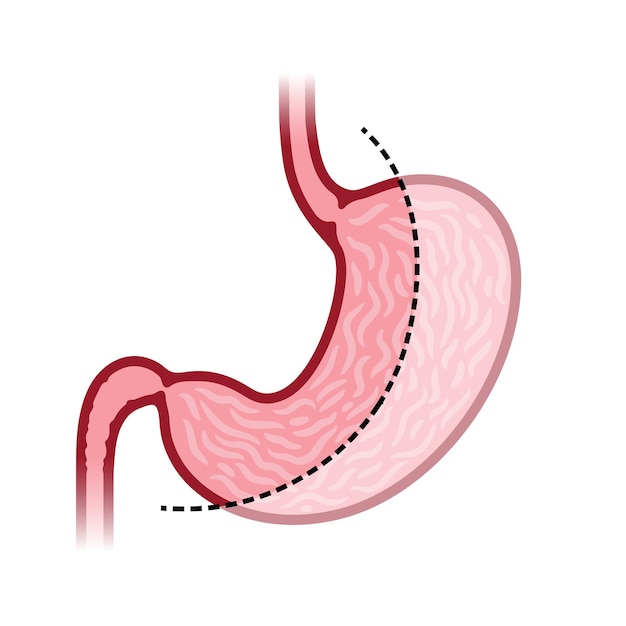 Plik wektorowy laparoskopia rękawowa pionowa gastrektomia chirurgia żołądka odchudzanie chirurgia żołądka