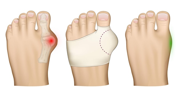 Leczenie Problemu Palucha Koślawego Z Bandażem Wystającej Kości Na Nodze