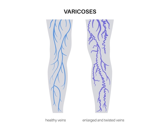Plik wektorowy leczenie żylaków