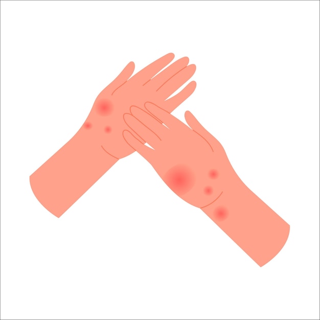 Plik wektorowy ludzkie ręce z reakcją alergiczną ręce pokryte czerwoną swędzącą wysypką