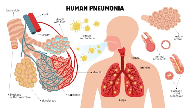 Plik wektorowy ludzkie zapalenie płuc zestaw elementów infografiki z anatomicznym schematem podstawowych elementów układu oddechowego z ilustracjami wektorowymi podpisów tekstowych