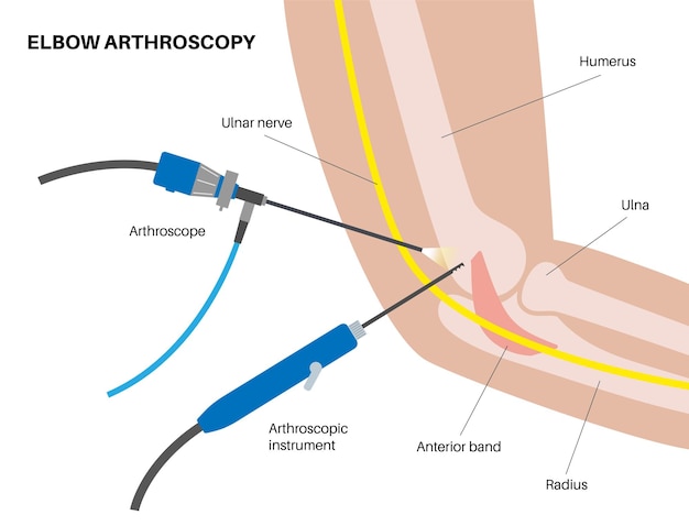 Plik wektorowy minimalnie inwazyjna operacja stawu łokciowego artroskopia procedura medyczna anatomia kości ramiennej, łokciowej i promieniowej ból ramienia złamanie choroba zwyrodnieniowa stawów lub reumatoidalne zapalenie stawów ilustracja prześwietlenie