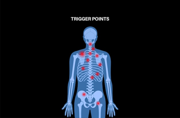 Plik wektorowy myofascialne punkty wyzwalające