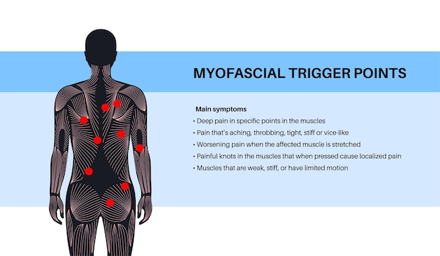 Plik wektorowy myofascialne punkty wyzwalające