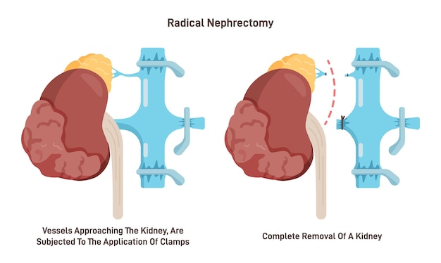 Plik wektorowy nefrektomia chirurgiczne usunięcie nerki choroba obrzęk nerki