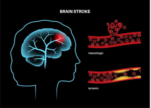 Plik wektorowy niedokrwienny i krwotoczny udar mózgu