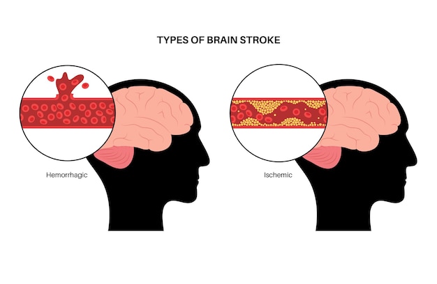 Niedokrwienny I Krwotoczny Udar Mózgu