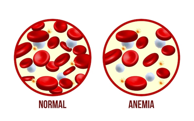 Niedokrwistość Z Niedoboru żelazaróżnica Niedokrwistości Ilość Czerwonych Krwinek I Normalna