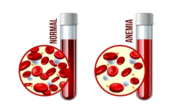 Plik wektorowy niedokrwistość z niedoboru żelazaróżnica niedokrwistości ilość czerwonych krwinek i normalna