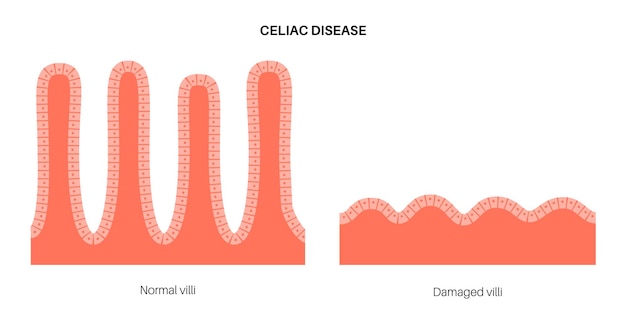 Nietolerancja Glutenu. Uszkodzone I Zdrowe Kosmki Jelitowe Na Powierzchni ścian Jelit.
