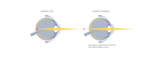 Plik wektorowy normalne oko i dalekowzroczność