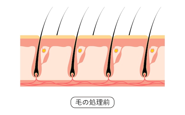 Plik wektorowy obraz usuwania włosów przed i nieleczonych włosów tłumaczenie przed leczeniem włosów