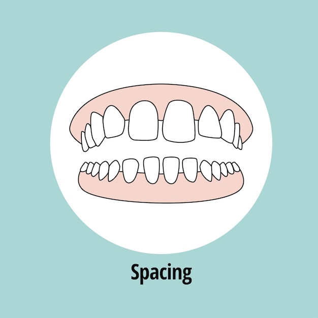 Open Bite Ilustracja Wektorowa Problem Stomatologiczny Koncepcja Opieki Stomatologicznej