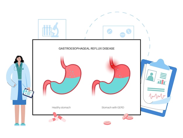 Plakat Choroby Refluksowej Przełyku. Zdrowy żołądek I Zapalenie Gerd W Organizmie Człowieka. Ból, Zgaga W Klatce Piersiowej, żołądku I Przełyku. Otwarty Zwieracz Umożliwia Płaską Ilustrację Wektorową Refluksu Kwasowego
