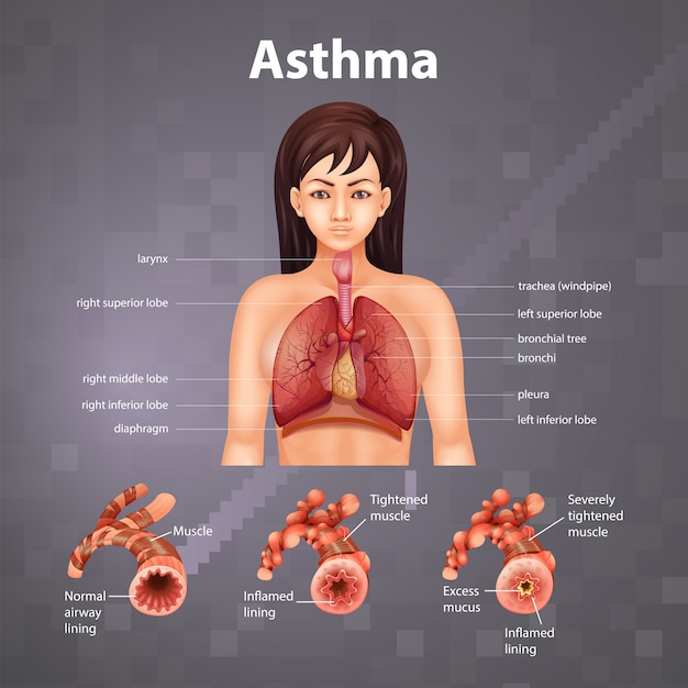 Porównanie Zdrowego Płuca I Płuc Z Astmą