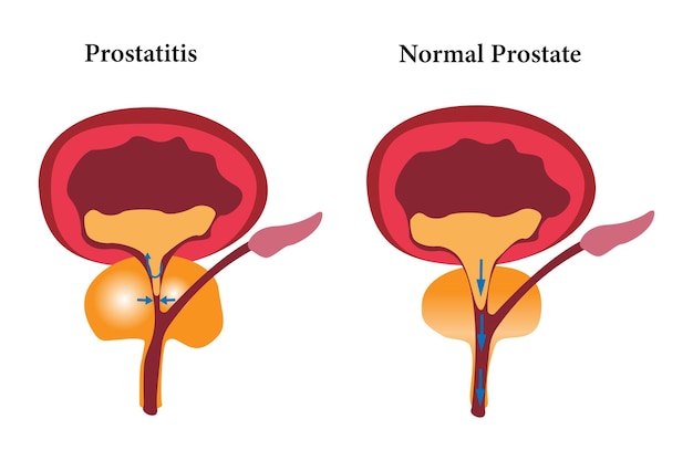 Porównanie zdrowej prostaty i niezdrowej prostaty zestaw ilustracji ikon