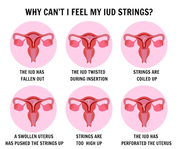 Powoduje, że Nie Czuje Się Strun Iud. Wkładka Wewnątrzmaciczna W Wektorze