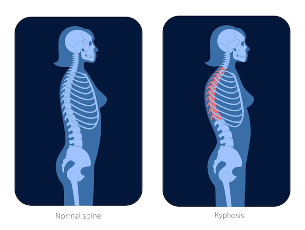 Plik wektorowy prawidłowy kręgosłup i kifoza w ciele kobiety. ilustracja wektorowa płaskie rentgenowskie. anatomia kręgosłupa i szkieletu w kobiecej sylwetce. plakat ortopedyczny. baner medyczny dla kliniki. egzamin w ośrodku bólu kręgosłupa