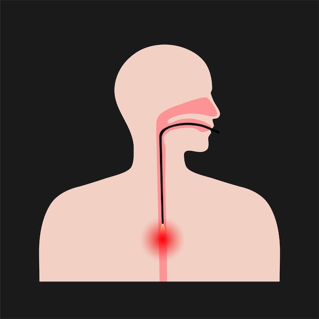 Plik wektorowy procedura endoskopii przełyku