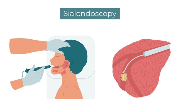 Procedura Sialendoskopii