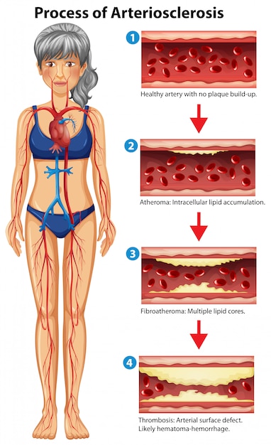 Proces Miażdżycy Medyczna Ilustracja