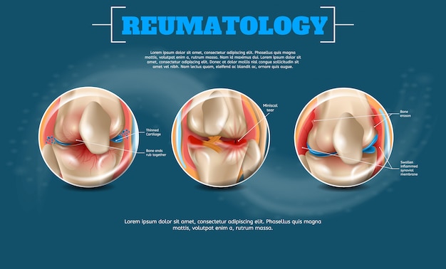 Realistyczna Ilustracja Reumatologia Z Szablonem Tekstu