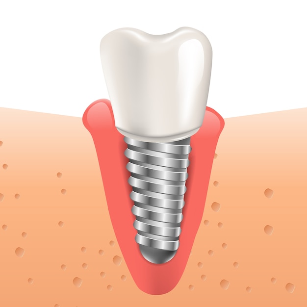 Realistyczne Ilustracja Implant Zęba W Grafice 3d