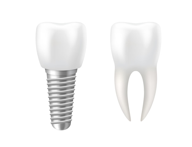 Plik wektorowy realistyczny ząb i implant dentystyczny dla stomatologii