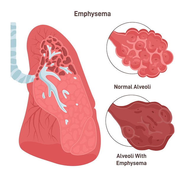 Plik wektorowy rozedma płuc przewlekła obturacyjna choroba płuc spowodowana paleniem