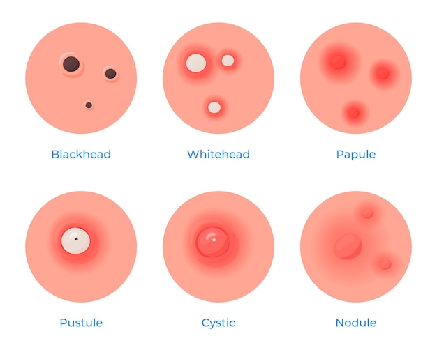 Plik wektorowy różne rodzaje problemów skórnych pryszcze, czarne plamy trądzik pielęgnacja skóry ilustracja wektorowa