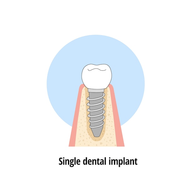 Rozwiązanie ubytku zębowego za pomocą implantu unitarnego i korony Zdrowe zęby