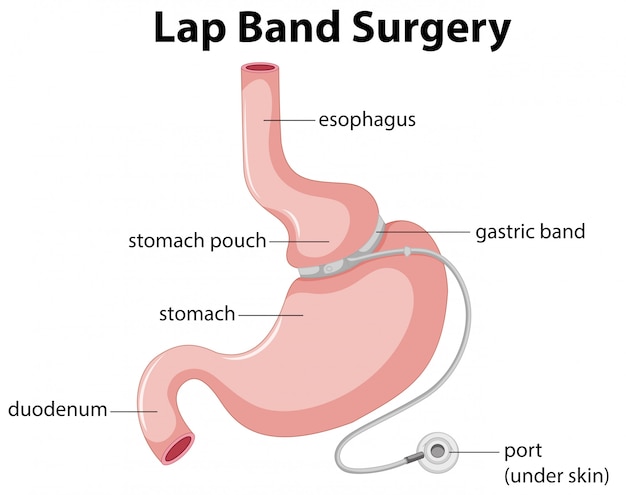 Schemat Chirurgii Lap Band