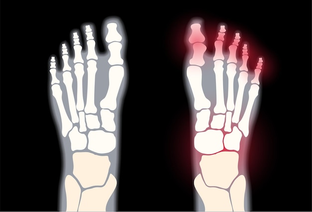 Plik wektorowy staw stopy stawów. ból reumatoidalny w płaskiej ilustracji wektorowych nogi