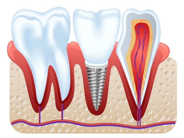 Struktura Implantu Dentystycznego.