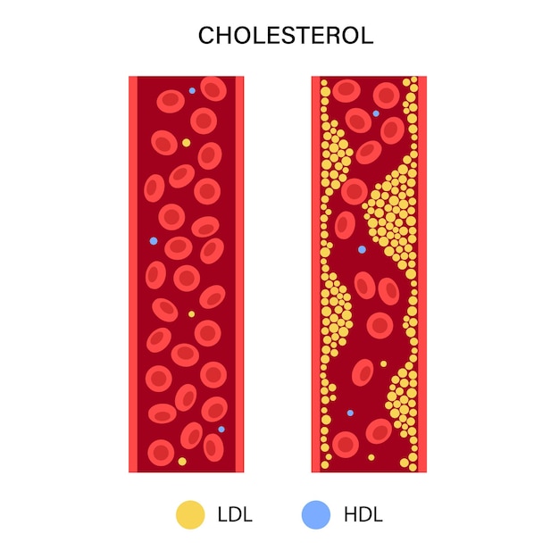 Plik wektorowy tętnica krwi cholesterolowa