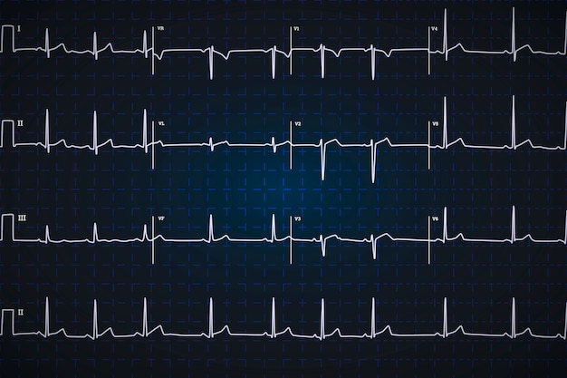 Typowy Ludzki Elektrokardiogram, Biały Wykres Na Ciemnym Niebieskim Tle