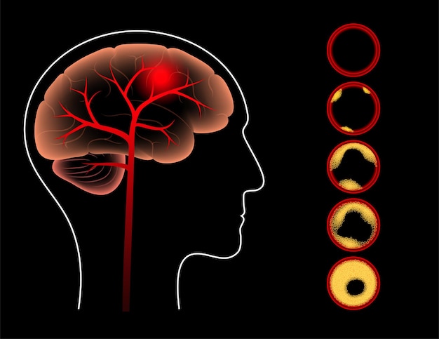 Plik wektorowy udar mózgu niedokrwienny