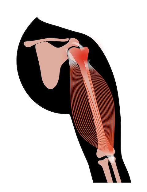 Uraz bicepsa