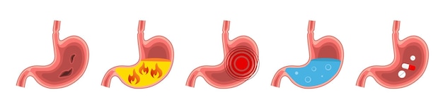 Ustawić Zdrowy I Chory żołądek Ból żołądka Niestrawność Niestrawność Wymioty Zgaga Układ Pokarmowy