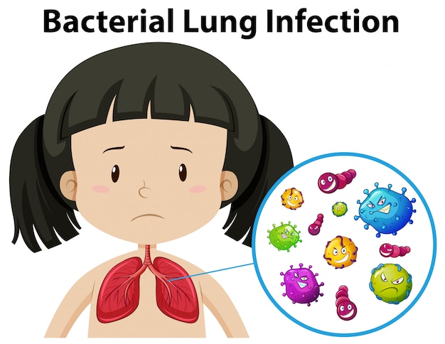 Wektor Bakteryjnej Infekcji Płuc