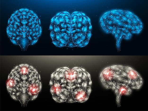 Wielokątne Ilustracje Wektorowe Zdrowego Mózgu I Chorego Mózgu Z Ogniskami Zapalnymi