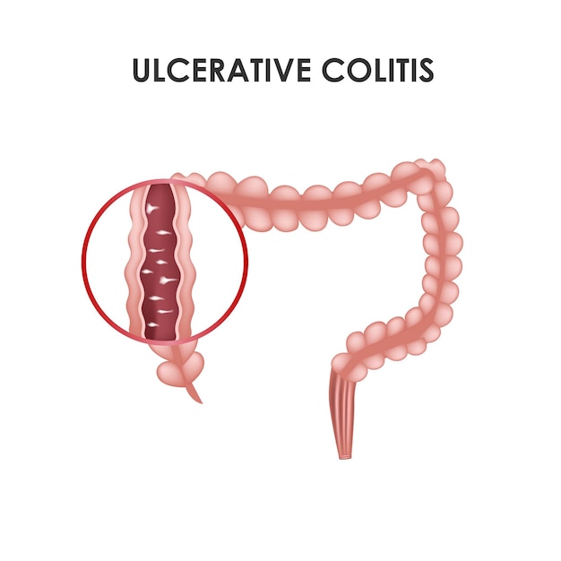 Wrzodziejące Zapalenie Jelita Grubego Ilustracja Wektorowa Medyczna