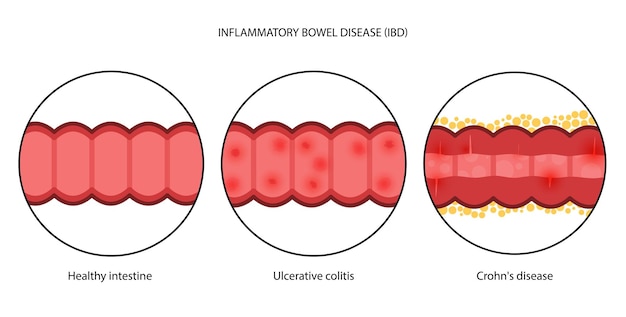 Plik wektorowy zapalna choroba jelit