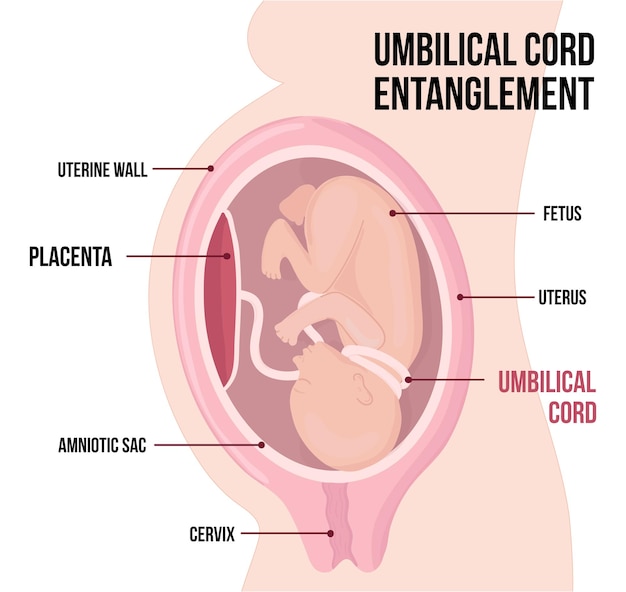 Plik wektorowy zaplątanie pępowiny wokół płodu
