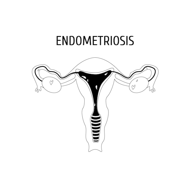 Zarys żeńskich Narządów Płciowych Endometrioza