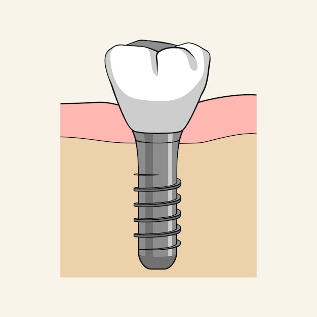 Plik wektorowy zbliżenie implantu dentystycznego