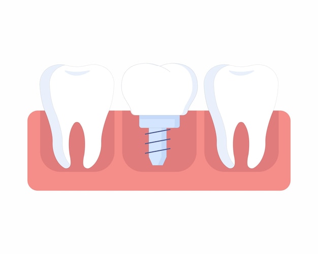 Plik wektorowy zdrowy ząb i implant dentystyczny, higiena jamy ustnej ludzkich zębów.