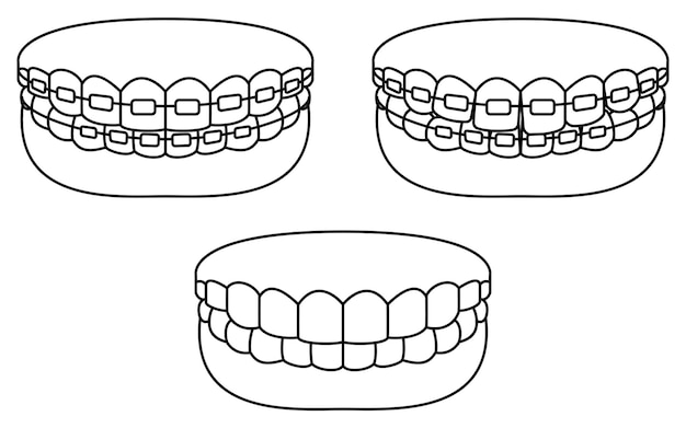 Plik wektorowy zęby z metalowymi nawiasami w stomatologii kosmetycznej i ortodoncji