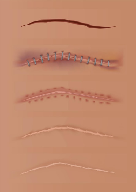 Zestaw Gojących Się Ran, Blizn Skórnych, Zszytych Ran I Skaleczeń. Realistyczne Szwy Chirurgiczne, Szyte Rany Na Różnych Etapach Gojenia. Nagromadzenie Pęknięć W Tkance Ciała.